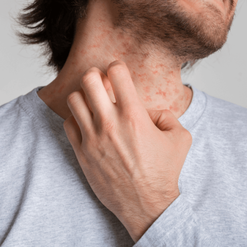 Itchy Skin Alcohol Withdrawal